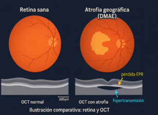 Prótesis ocular