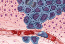 Científicos crean la vacuna que podría acabar con el cáncer de colon para siempre