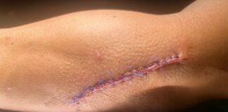 Herida suturada en el brazo del mosso d'Esquadra que resultó herido durante la detención de dos hermanos en Vic.