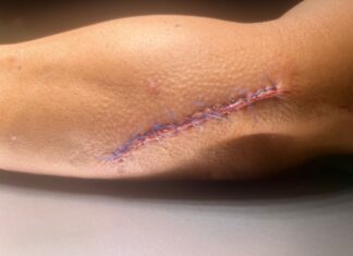 Un mosso acaba con 17 puntos de sutura tras una violenta detención de dos hermanos multirreincidentes en Vic Herida suturada en el brazo del mosso d'Esquadra que resultó herido durante la detención de dos hermanos en Vic.