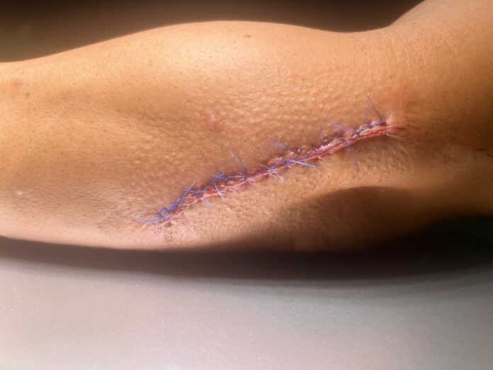 Herida suturada en el brazo del mosso d'Esquadra que resultó herido durante la detención de dos hermanos en Vic.